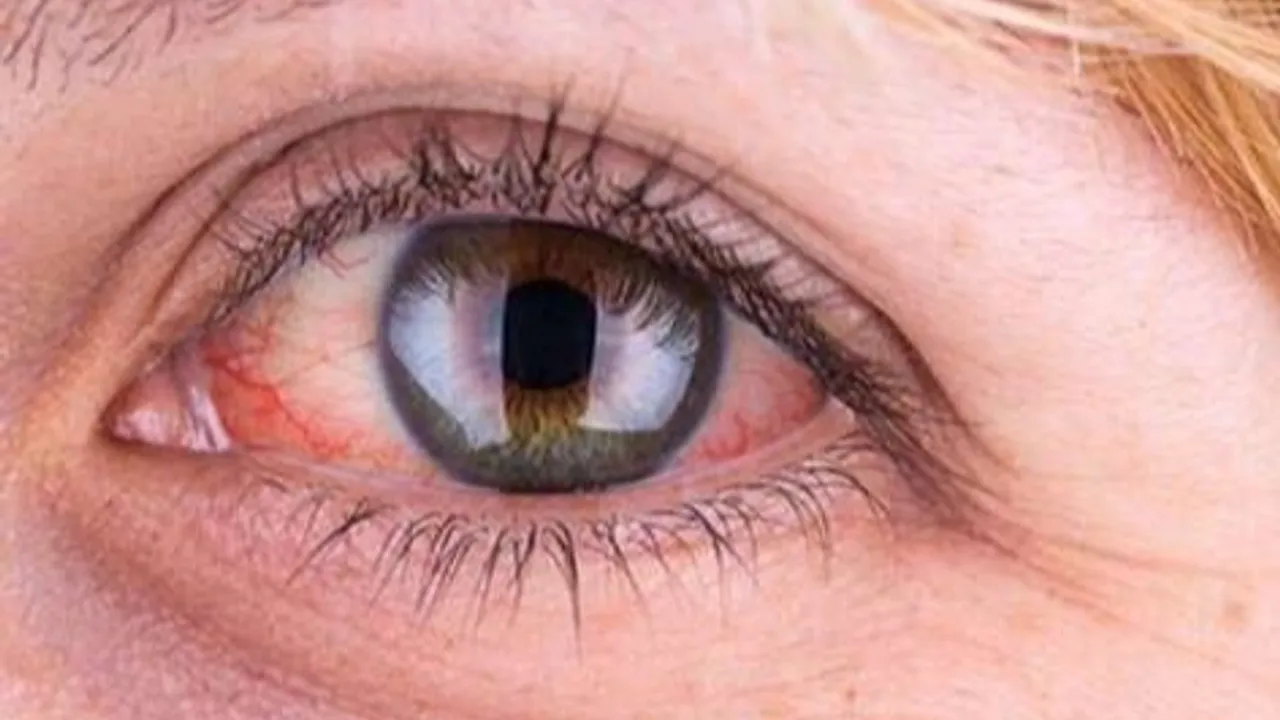 Yaz serinliği göz sağlığınızı tehdit etmesin: 6 koruyucu öneri