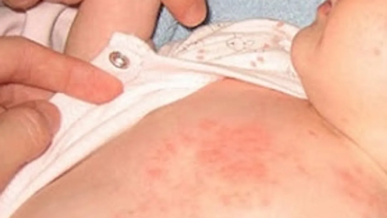 Çocuklarda isilik tehlikesine dikkat